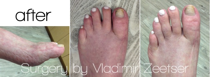 5 Months Postoperative After Hallux Varus