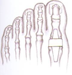 Hallux Limitus/Rigidus (Stiff Big Toe) Correction With Implant Arthroplasty