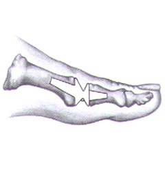Hallux Limitus/Rigidus (Stiff Big Toe) Correction With Implant Arthroplasty