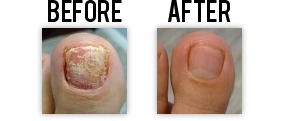 Laser Fungal Nail