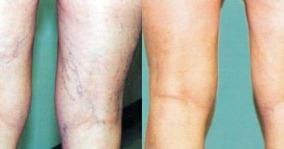 Sclerotherapy