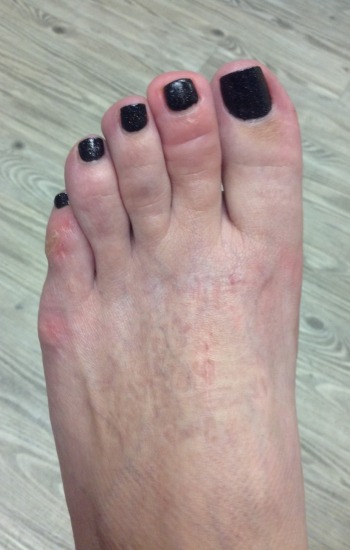 After Toe Shortening Surgery