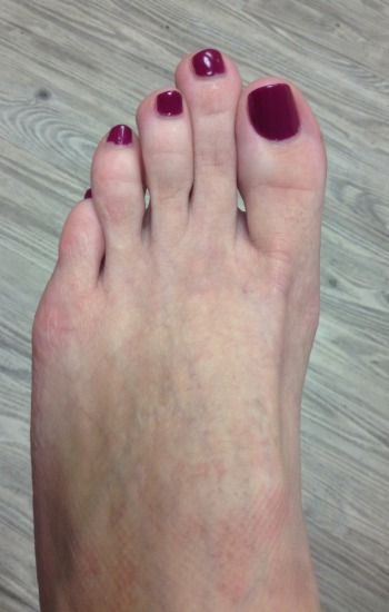 Before Toe Shortening Surgery