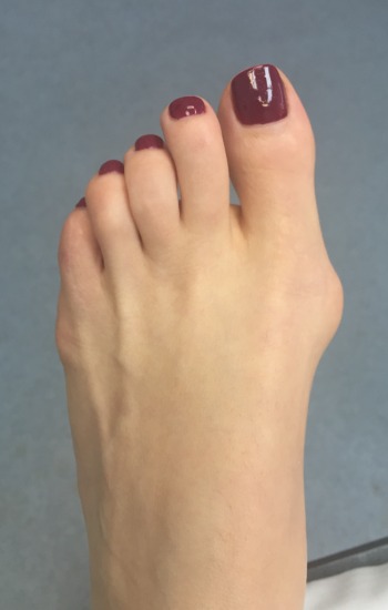 Before fastforward bunion correction