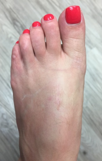 After fastforward bunion correction