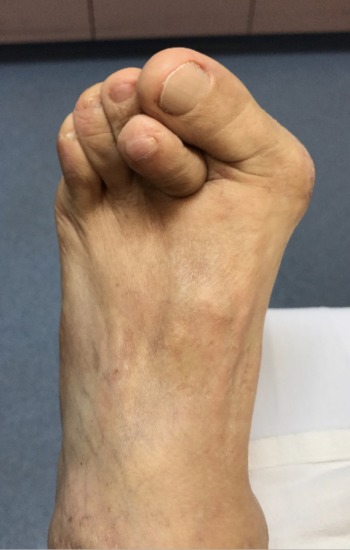 63 year old male before and after FastForward Bunion Corrections System