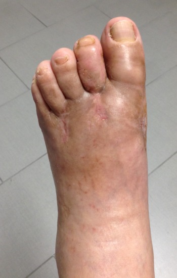 63 year old male before and after FastForward Bunion Corrections System