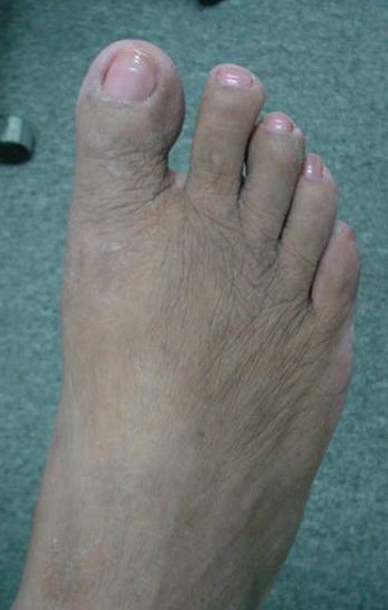 No visible incision scar on the top of the foot