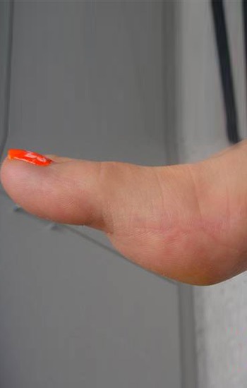 Minimal to no visible scar at incision site on the side of the foot