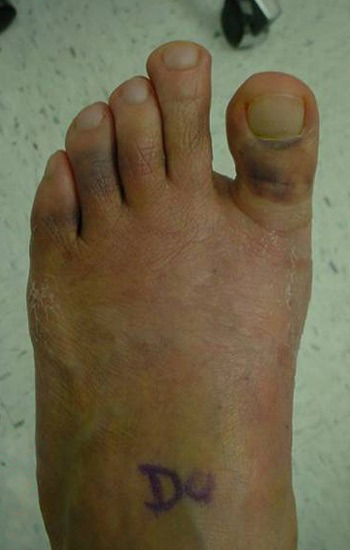 No visible incision scar on the top of the foot