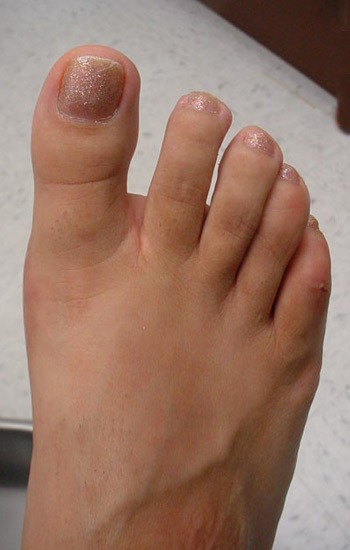 No visible incision scar on the top of the foot