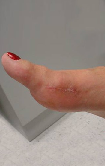 Minimal incision scar on the side of the foot