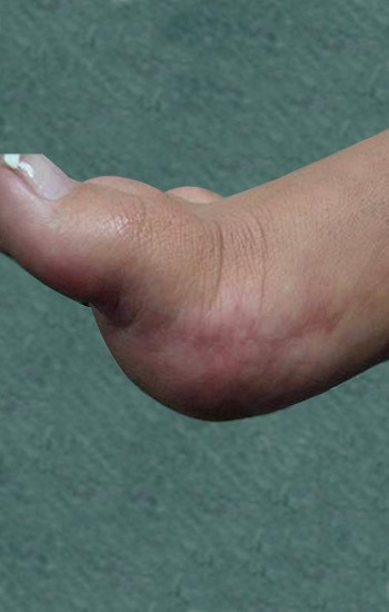 Minimal incision scar visible on the side of the foot