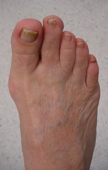 bunion deformity