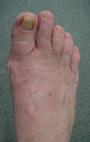 No incision scar visible on the top of the foot