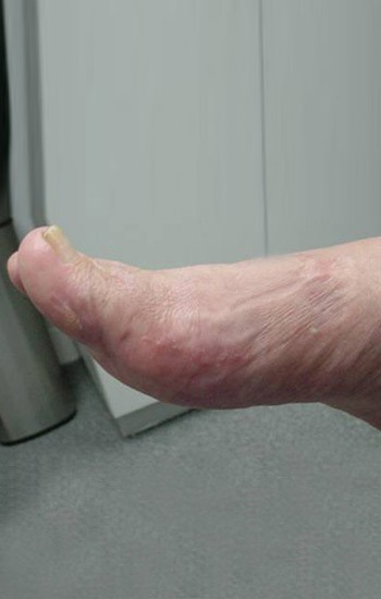 Minimal to no incision scar visible on the side of the foot