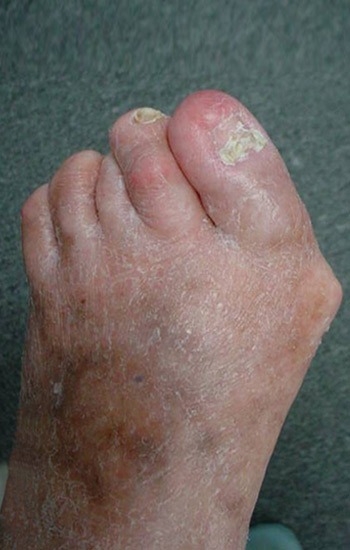 severe bunion and contracted toe deformities