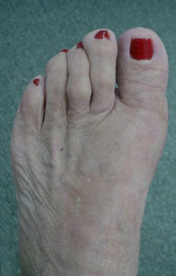 No visible incision scar on the top of the foot