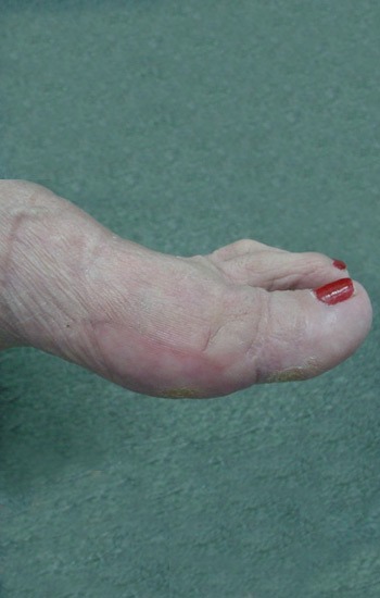 Minimal to no scar visible on the side of the foot