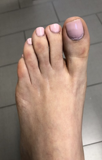 After Toe Shortening Surgery