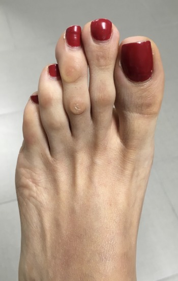 Before Toe Shortening Surgery